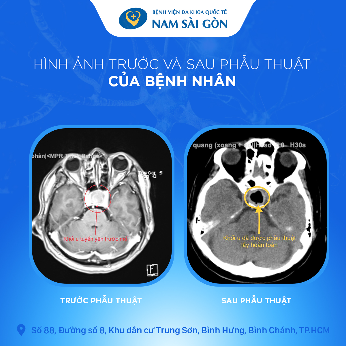 Trước Và Sau Phẫu Thuật Của Bệnh Nhân U Tuyến Uyên