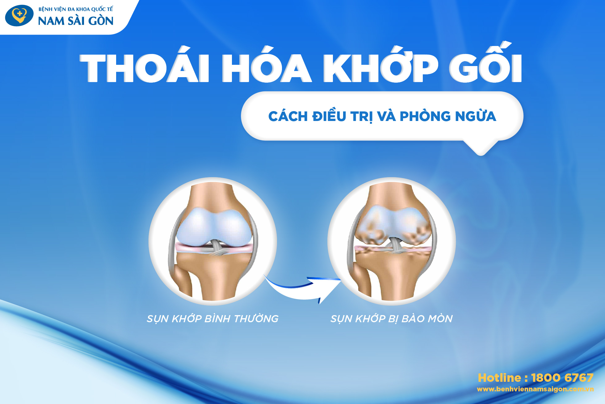 THOÁI HÓA KHỚP GỐI: NGUYÊN NHÂN, TRIỆU CHỨNG, ĐIỀU TRỊ VÀ PHÒNG NGỪA