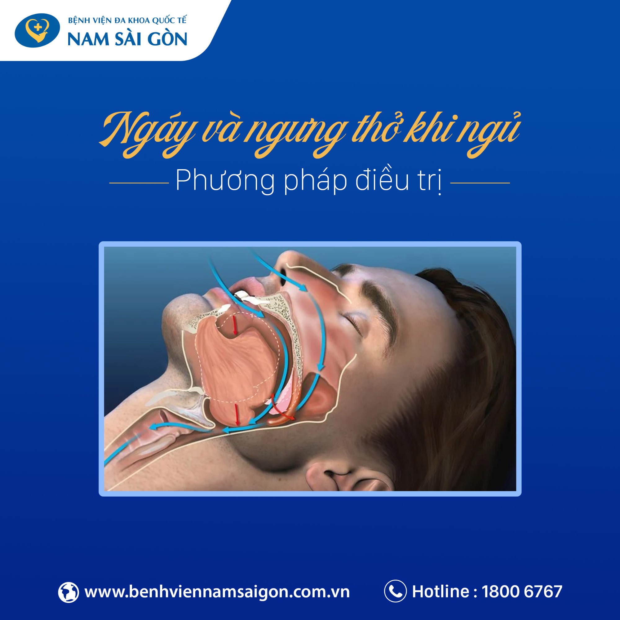 Dịch vụ điều trị Ngáy và ngưng thở khi ngủ