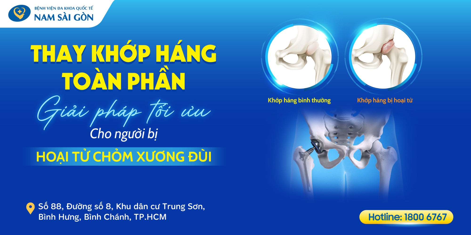 THAY KHỚP HÁNG TOÀN PHẦN - GIẢI PHÁP TỐI ƯU CHO NGƯỜI BỊ HOẠI TỬ CHỎM XƯƠNG ĐÙI