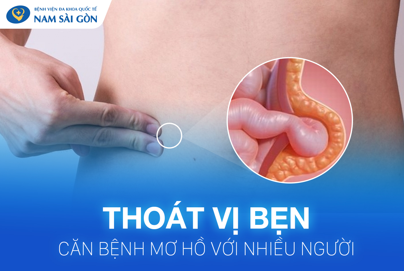 THOÁT VỊ BẸN VÀ NHỮNG ĐIỀU CẦN BIẾT