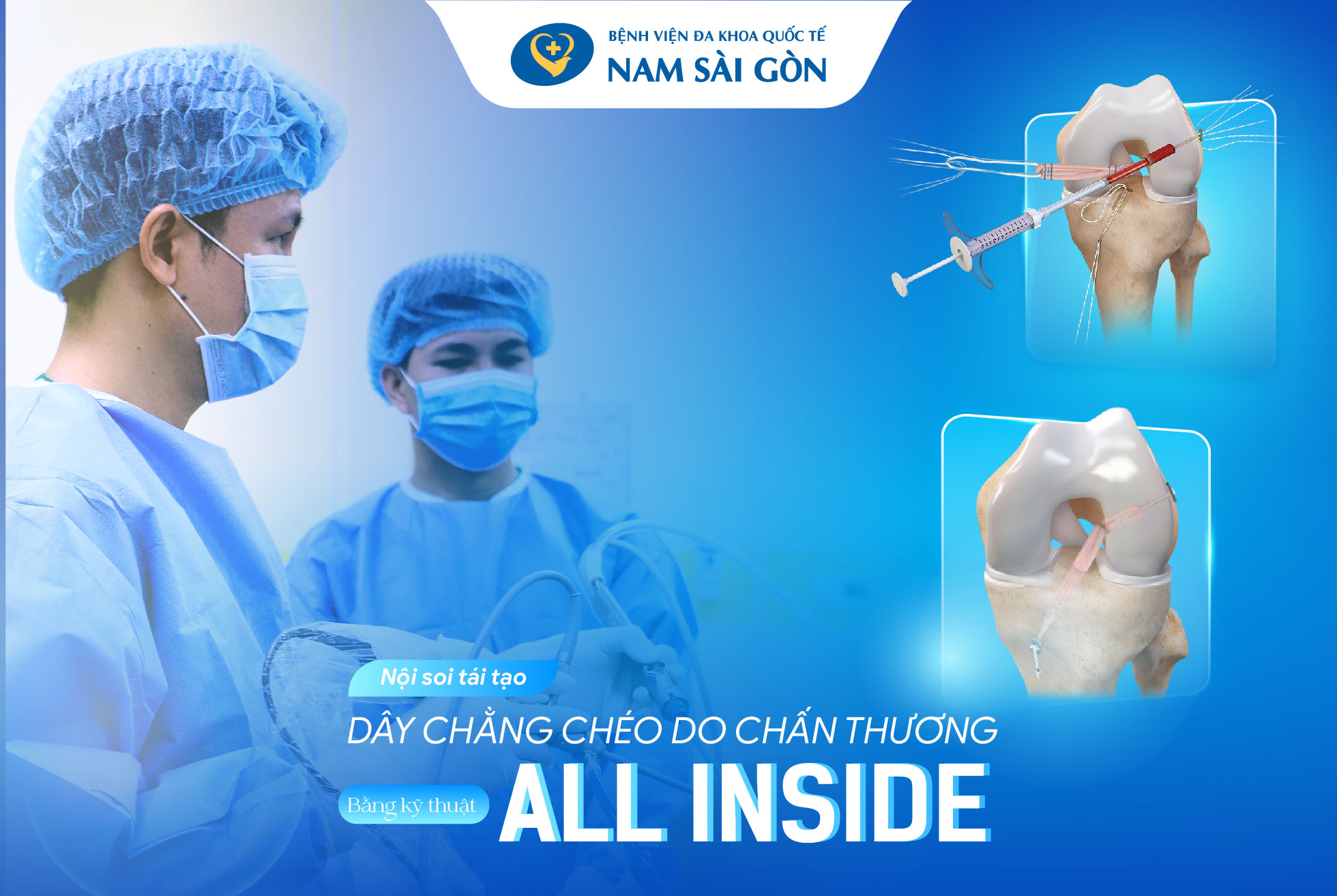 PHỤC HỒI NHANH SAU NỘI SOI TÁI TẠO DÂY CHẰNG CHÉO BẰNG KỸ THUẬT ALL INSIDE