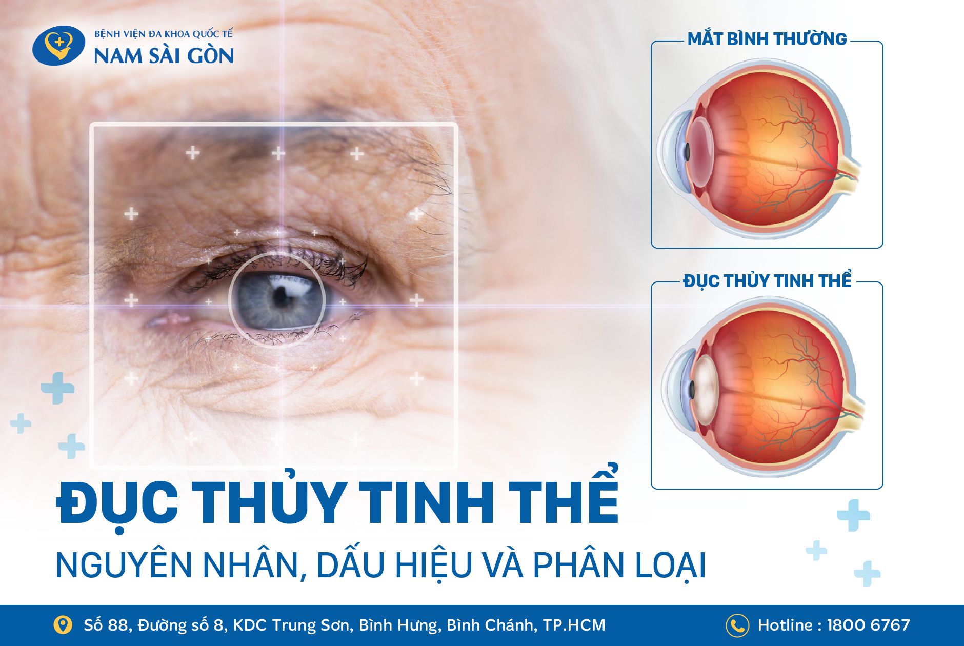 ĐỤC THỦY TINH THỂ: NGUYÊN NHÂN, DẤU HIỆU VÀ PHÂN LOẠI